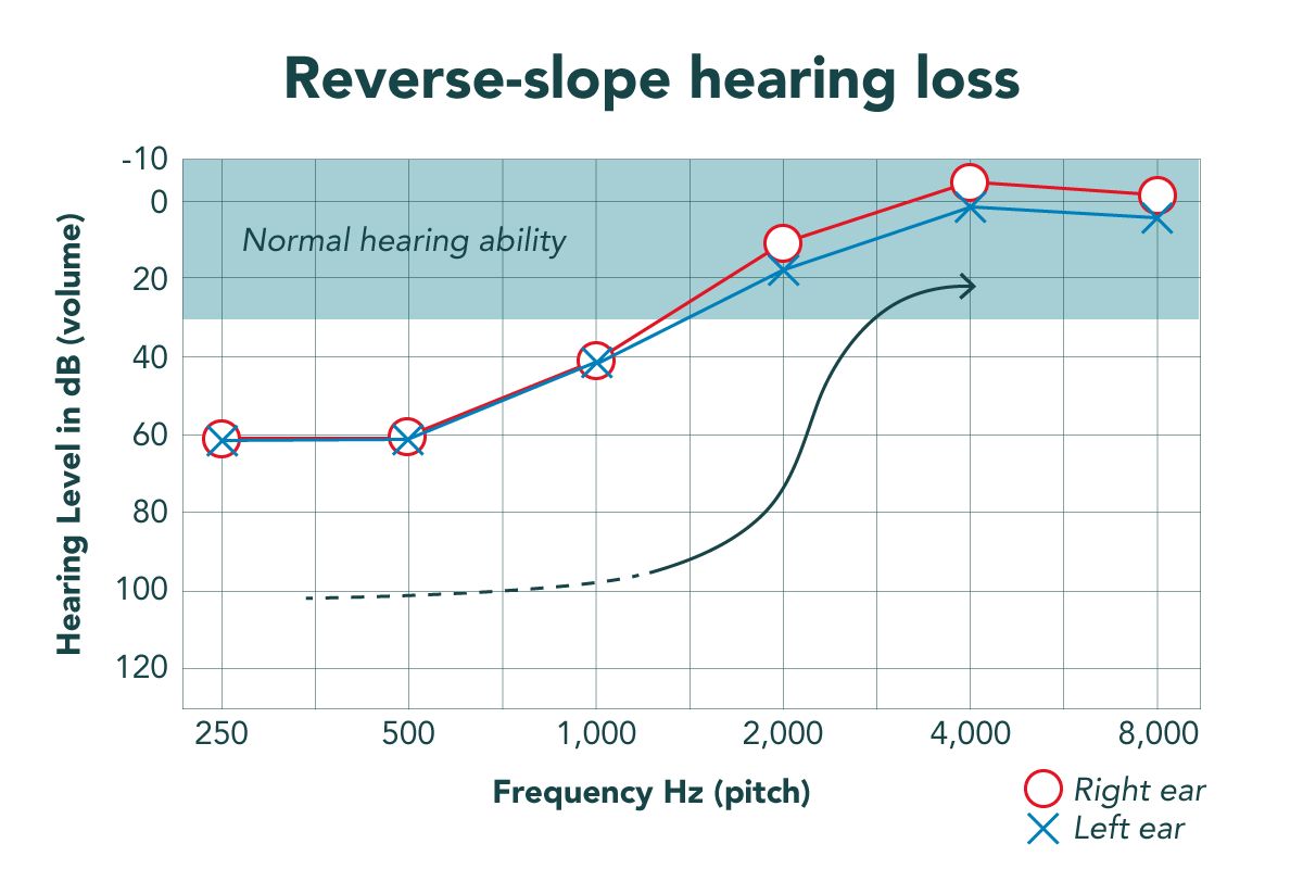 What Is Low Frequency Hearing Loss Causes And Cure Miracle Ear